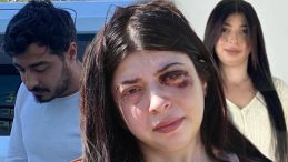Sokak Ortasında Dehşeti Yaşamıştı: Yüzümde Bir Demirle Sonsuza Dek Yaşamaya Mahkum Bırakıldım