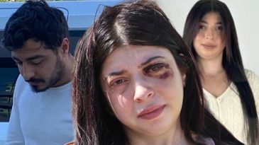 Sokak Ortasında Dehşeti Yaşamıştı: Yüzümde Bir Demirle Sonsuza Dek Yaşamaya Mahkum Bırakıldım