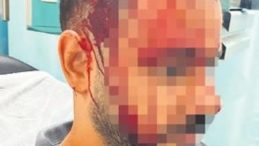 Kavgayı Ayırmak İsterken Darp Edildi