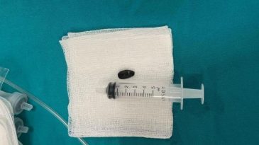 15 Aylık Bebek Akciğerine &Ccedil;ekirdek Kabuğu Ka&ccedil;tığı İ&ccedil;in Acil M&uuml;dahale Gerekti