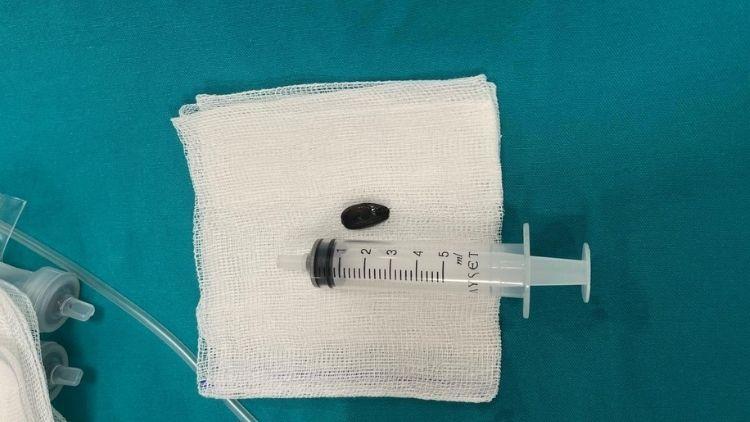 15 Aylık Bebek Akciğerine Çekirdek Kabuğu Kaçtığı İçin Acil Müdahale Gerekti