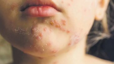 ABD'de Kızamık Vaka Sayısı 33 Yılın En Y&uuml;ksek Seviyesine Ulaştı