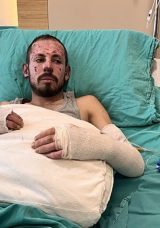 Arızalı Ara&ccedil;la Yaşanan Kaza Bedirhan Acar'ı Yaraladı