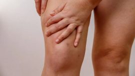 Bacaklarınızdaki Anormal Yağ Birikimine Dikkat! Uzmanlardan &Ouml;nemli Uyarı: Bu Rahatsızlık Kadınlarda Daha Yaygın&hellip;