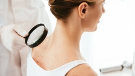 Uzmanı Uyardı: Yanıklar Yıllar Sonra Kanser Gelişimine Neden Olabilir!