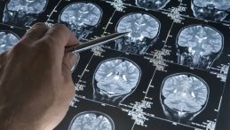 Beyninizdeki Bu Değişime Dikkat! Alzheimer'ın İlk Belirtisi