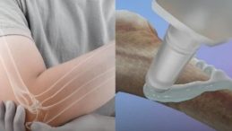 &Ccedil;ığır A&ccedil;an Buluş: Kırıkları 3 Dakikada Onarıyor