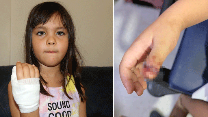 Antalya'da Anaokulunda Korkun&ccedil; Olay! 4 Yaşındaki &Ccedil;ocuğun Parmağı, Demir Kapıya Sıkışarak Koptu