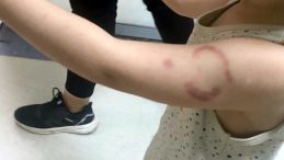 Edirne'de Öğrencisini Isırdığı Gerekçesiyle Gözaltına Alınan Kadın Hakkında Karar Verildi: 'Çocuğum Travma Geçirdi'