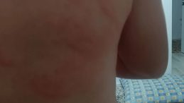 Elazığ'da Şaşırtan Olay | Vücudu Şişti, Hastaneye Kaldırıldı: Sebebi Şaşırttı!