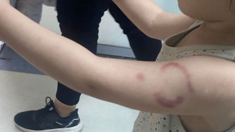 Kreş Öğretmeni 3 Yaşındaki Çocuğun Kolunu Isırdı