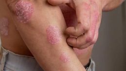 &lsquo;Sedef hastalığı artık y&uuml;zde y&uuml;z iyileşiyor&rsquo;