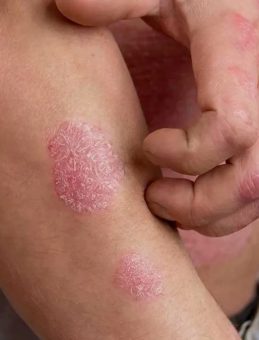 ‘Sedef hastalığı artık yüzde yüz iyileşiyor’