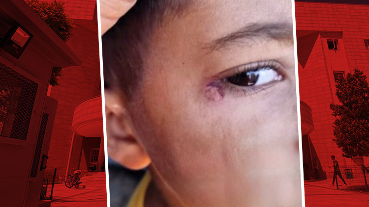 Okul Temizlik Görevlisi, 7 Yaşındaki Çocuğun Yüzünde Sigara Söndürdü