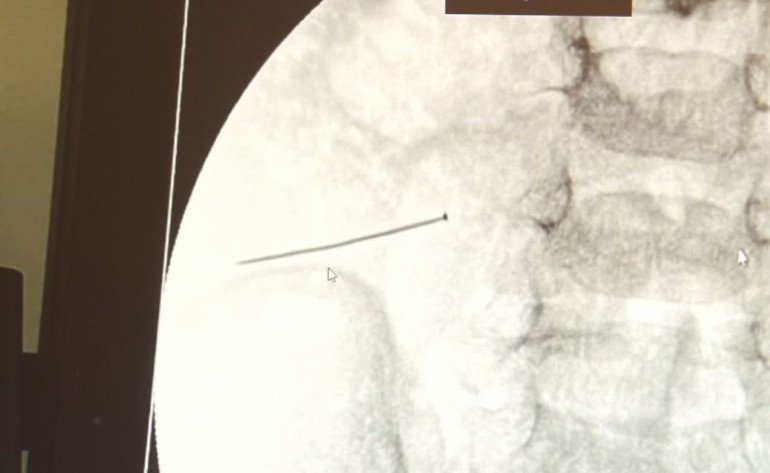 Yabancı Cisim Görüntüsü