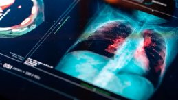 Akciğerleri Yok Eden Sessiz Tehlike! Uzmanlardan Korkutan Uyarı: "İnsanların %80&rsquo;i Bu Hastalıktan Habersiz&hellip;&rdquo;