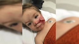 Ankara&rsquo;da 1,5 ve 5 yaşındaki kardeşler pitbull saldırısına uğradı