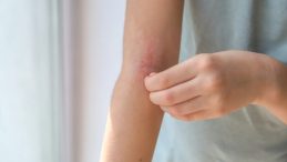 &Ccedil;ocuğunuzun Cildindeki Kabarık Kızarıklıklar İ&ccedil;in Uzmanlardan &Ouml;nemli Uyarı!