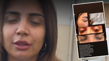 G&uuml;zellik Merkezi Facialı: G&ouml;zde Yapıştırıcı Tehlikesi