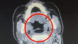 Kayseri'de Uyuşturucu Operasyonu: Midesinden Yarım Kilo &Ccedil;ıktı!