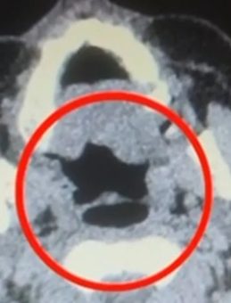 Kayseri'de Uyuşturucu Operasyonu: Midesinden Yarım Kilo Çıktı!