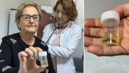 Antalya'da ilgin&ccedil; olay! Hapı al&uuml;minyum kabıyla yuttu, 4 yıl sonra akciğerinden b&uuml;t&uuml;n halde &ccedil;ıkarıldı… 'Meğer hapı yutmuşum'