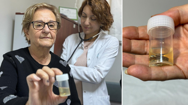 Antalya'da ilgin&ccedil; olay! Hapı al&uuml;minyum kabıyla yuttu, 4 yıl sonra akciğerinden b&uuml;t&uuml;n halde &ccedil;ıkarıldı… 'Meğer hapı yutmuşum'