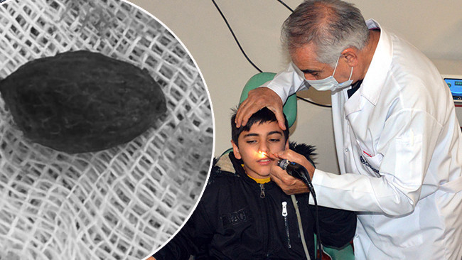 Kaşıntı Şikayetiyle Hastaneye Gitti: Burnundan &Ccedil;ıkanlar Ailesini Şaşırttı!