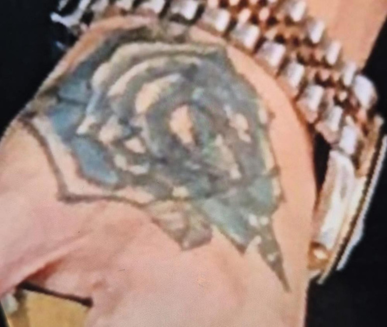 Dövme Sildirme İşlemi