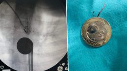 8 Yaşındaki &Ccedil;ocuk Madeni Para Yuttu!