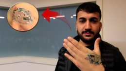 D&ouml;vme Sildirmek İsteyen Gen&ccedil; Kabusu Yaşadı, Elindeki Dokular &Ouml;ld&uuml;