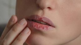 Elleriniz ve Dudaklarınız &Ccedil;atlıyor mu? İşte Sebepleri