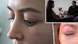 1.100 TL'lik G&uuml;zellik İşlemi Gen&ccedil; Kadının Kabusu Haline Geldi: Şikayeti Reddedildi | '&Ccedil;evremdekiler Fark Etti'