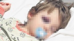 Baba ve 14 Aylık Kızına Vahşi Saldırı