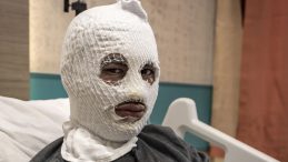 &Ccedil;akmağına Doldurduğu Gaz Az Kalsın Hayatına Mal Oluyordu: "Ben Yanmadım, Başkaları Yanmasın"