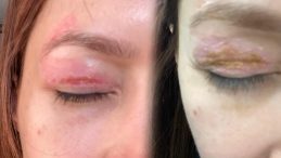 SON DAKİKA&hellip; G&uuml;zellik salonunda yaptırdığı plazma pen işlemi kabusu oldu! Bin 100 TL &ouml;dedi sonrası korkun&ccedil;&hellip;