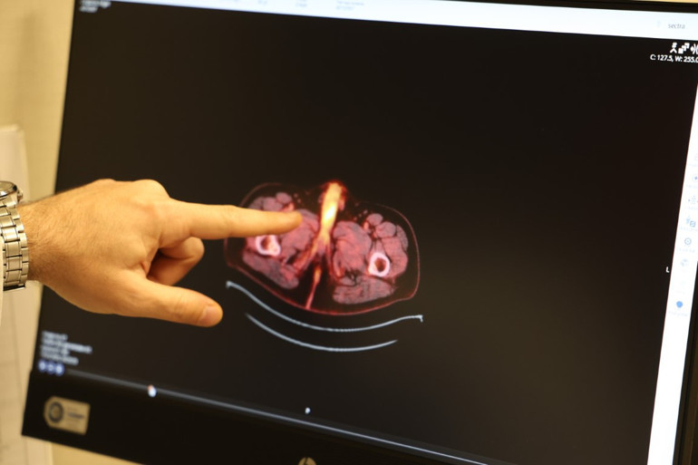 Kolon kanseri farkındalığı