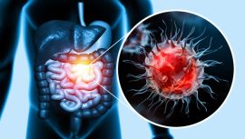 Sessiz ilerliyor: Kolon kanserinin en yaygın belirtileri a&ccedil;ıklandı