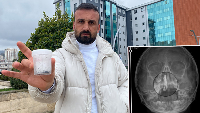 Şiddetli kanama ve akıntı şikayetiyle gitti: 5 yaşındaki Polen'in 2 yıl boyunca burnundaymış! ''Bu nasıl g&ouml;zden ka&ccedil;ılabilir?'