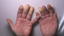 Soğukta parmaklarınız morarıyorsa dikkat! Raynaud hastalığının habercisi olabilir