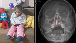 SON DAKİKA&hellip; Şiddetli kanama ve akıntı şikayetiyle gitti! Doktorlar bile şoka girdi: 5 yaşındaki Polen&rsquo;in burnundan bakın ne &ccedil;ıktı!
