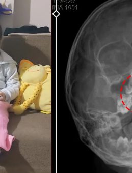 SON DAKİKA… Şiddetli kanama ve akıntı şikayetiyle gitti! Doktorlar bile şoka girdi: 5 yaşındaki Polen’in burnundan bakın ne çıktı!