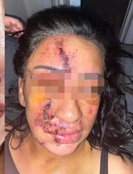 Yine Estetik Faciası