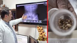 31 Yaşındaki Kadın Yıllarca Bu Ağrıyla Yaşadı! Ameliyata Giren Doktor Bile Şaşırdı