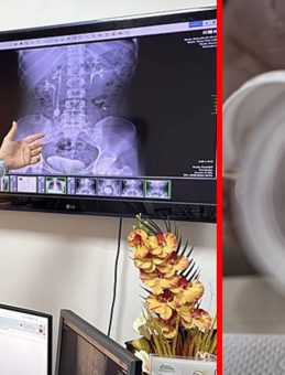 31 Yaşındaki Kadın Yıllarca Bu Ağrıyla Yaşadı! Ameliyata Giren Doktor Bile Şaşırdı