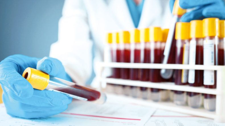 Alzheimer&rsquo;da Kan Testi Umudu