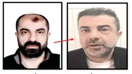 Azmettirici Ameliyatla Y&uuml;z&uuml;n&uuml; Değiştirmiş