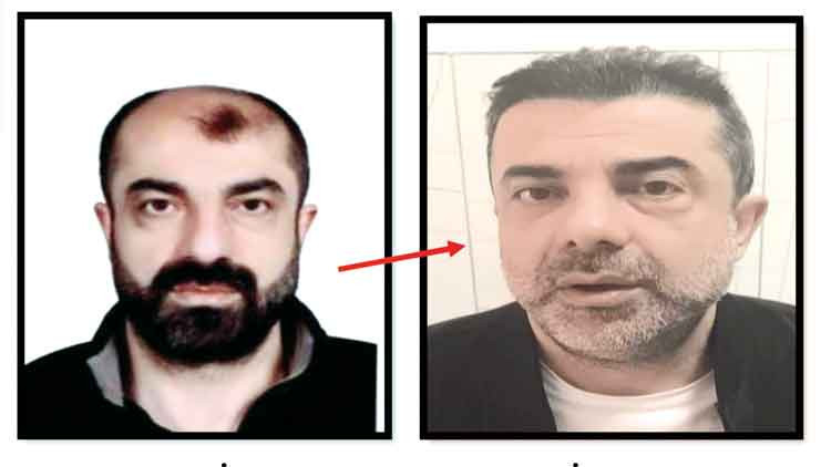 Azmettirici Ameliyatla Y&uuml;z&uuml;n&uuml; Değiştirmiş