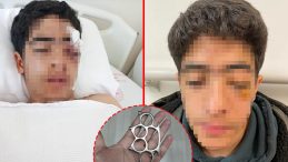 Esenyurt&rsquo;ta Akran Zorbalığı: 15 Yaşındaki &Ccedil;ocuğun G&ouml;z&uuml;n&uuml; Kaybetme Riski Var