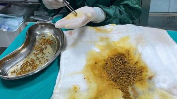 Karın ağrısı şikayeti ile gitti, sebebini &ouml;ğrenen doktorlar bile şaşkına d&ouml;nd&uuml;